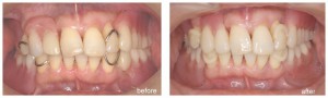 acatal_clasp